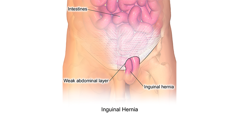 foto tipos de hernias - cirurgia de hernia em BH