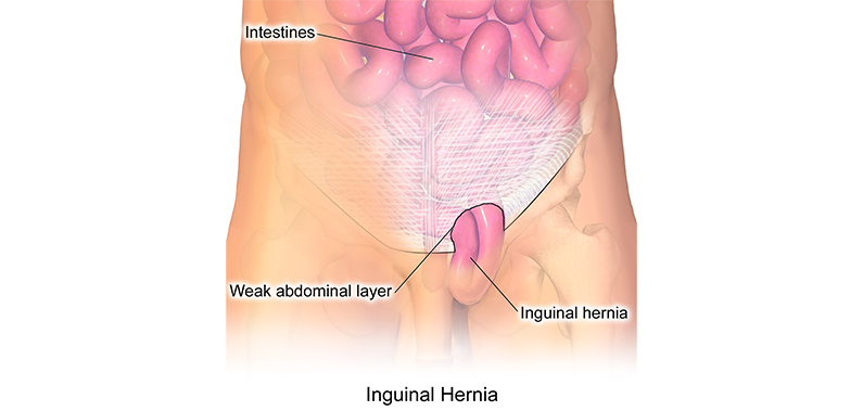 Hérnia Inguinal - CBCD